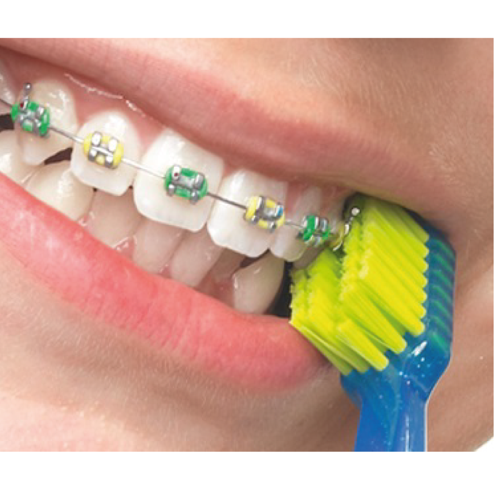 Zubná kefka CURAPROX CS 5460 Ultra Soft Ortho-oranžová